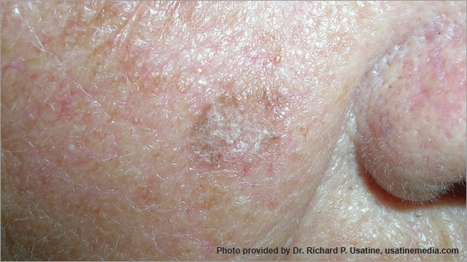 Facial Skin Cancer